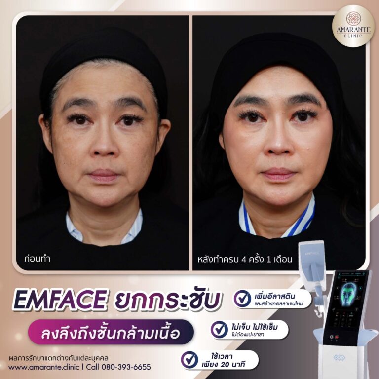 รีวิว Emface