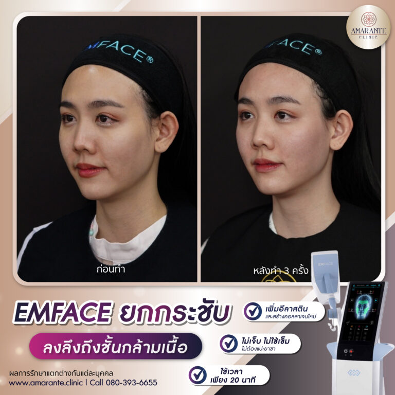 รีวิว Emface