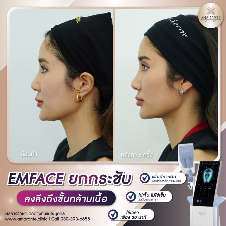 รีวิว Emface