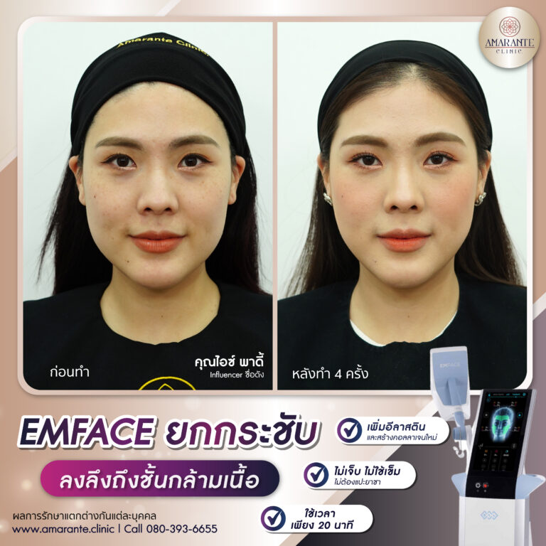 รีวิว Emface
