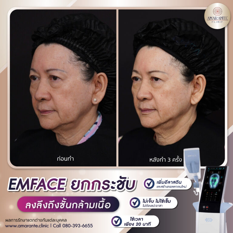 รีวิว Emface