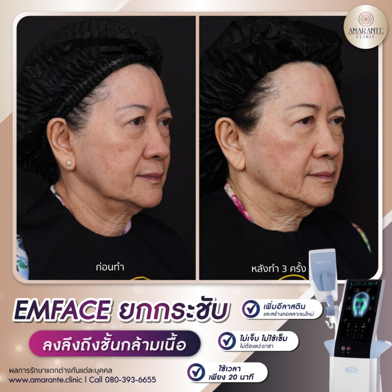 รีวิว Emface