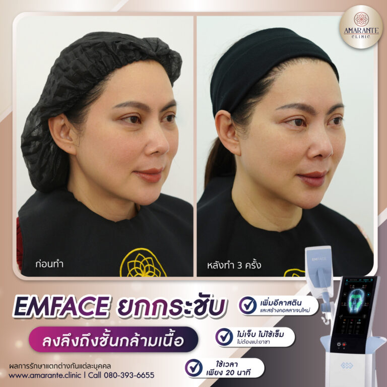 รีวิว Emface