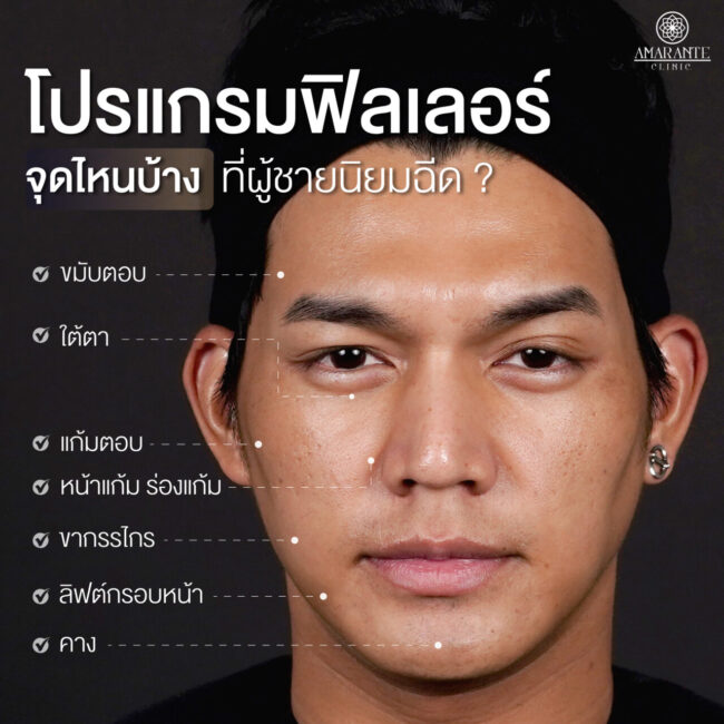ภาพ infographic แสดงจุดบนใบหน้าของผู้ชายว่าจุดไหนที่ผู้ชายนิยมฉีด