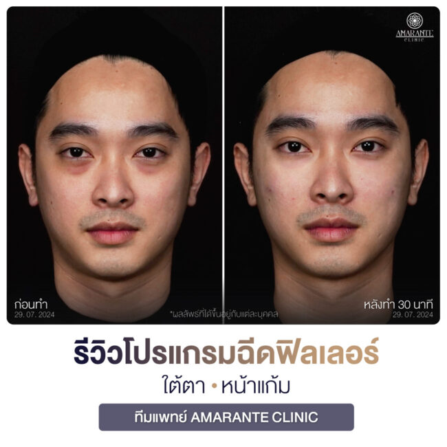 ภาพรีวิวฉีดฟิลเลอร์ผู้ชาย -09 ภาพรีวิวผลลัพธ์การฉีดฟิลเลอร์บริเวณใต้ตาและแก้ม ถ่ายในมุมตรง