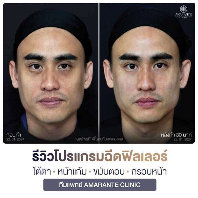 ภาพรีวิวฉีดฟิลเลอร์ผู้ชาย -15 ภาพรีวิวผลลัพธ์การฉีดฟิลเลอร์บริเวณใต้ตา แก้ม ขมับตอบและกรอบหน้า ถ่ายในมุมตรง