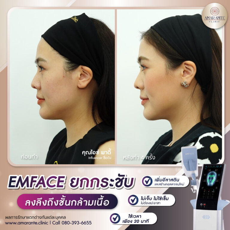 Emface รีวิว