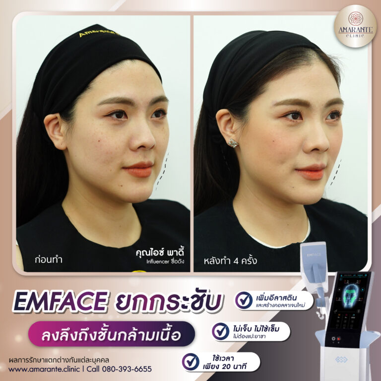 Emface รีวิว