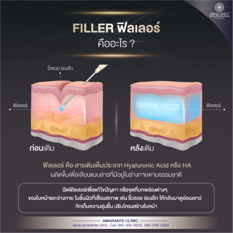 ฟิลเลอร์ คืออะไร