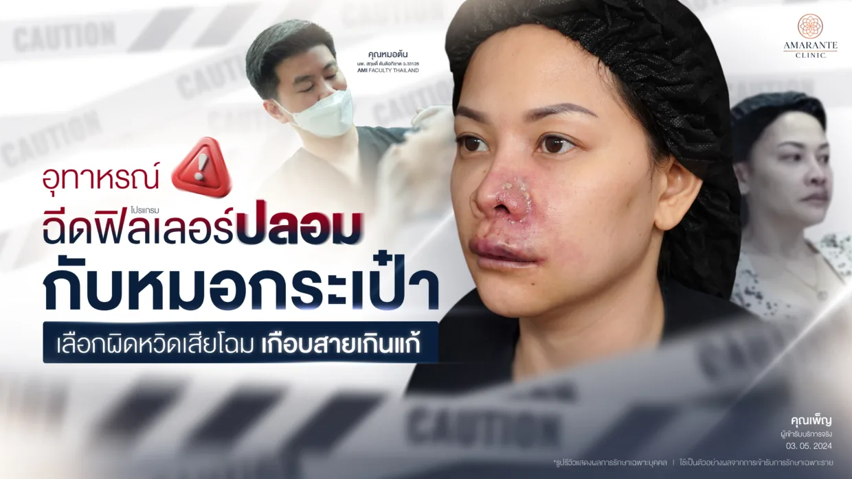 หมอกระเป๋า ฟิลเลอร์ปลอม