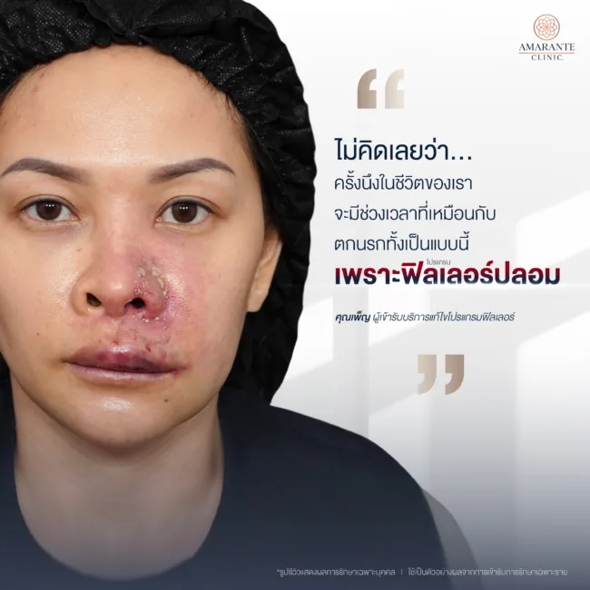 ฉีดฟิลเลอร์ปลอมกับหมอกระเป๋า