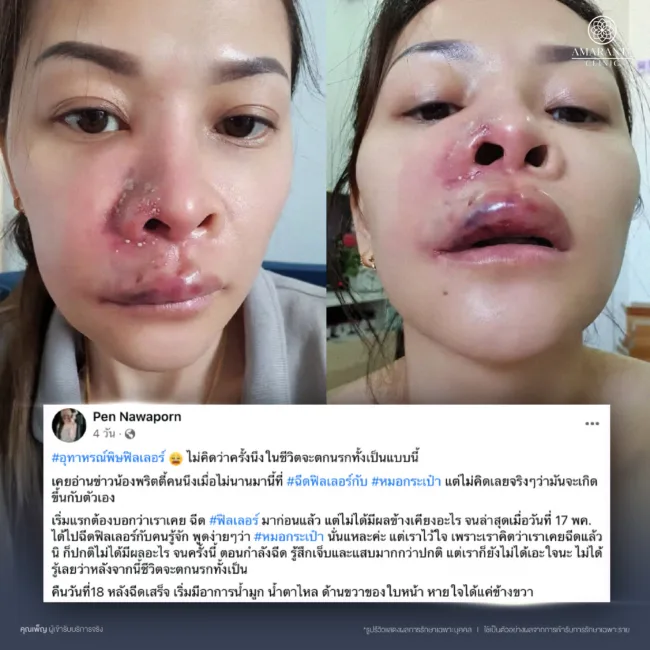 แก้ไขฟิลเลอร์จากฟิลเลอร์ปลอมก่อนจะสายที่ Amarante Clinic