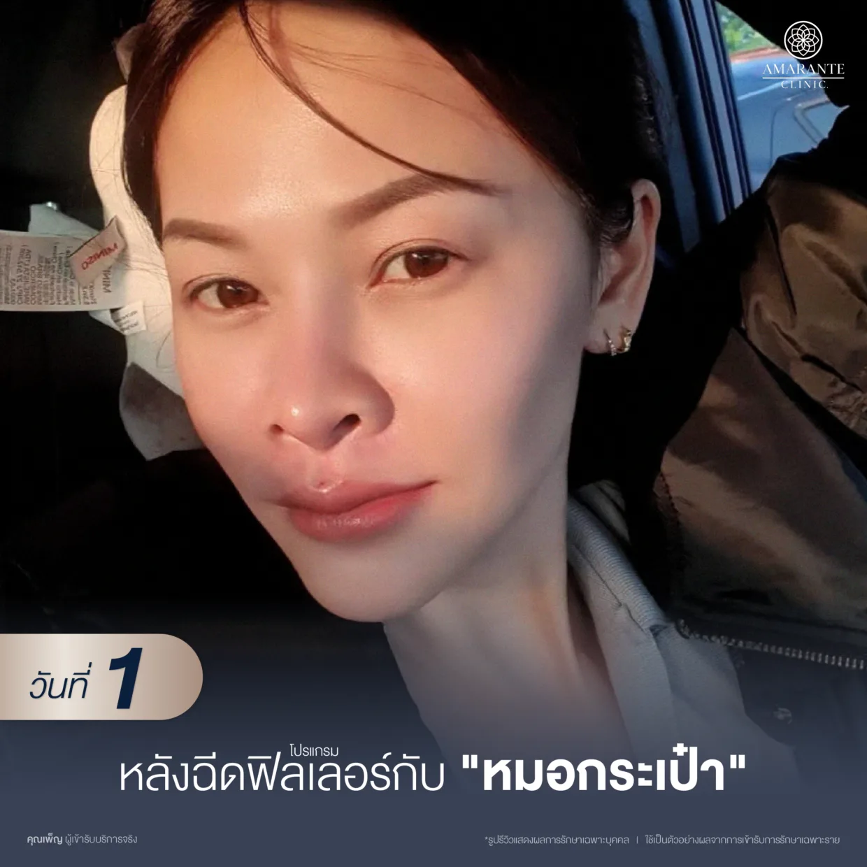 ฉีดฟิลเลอร์ปลอมวันที่1