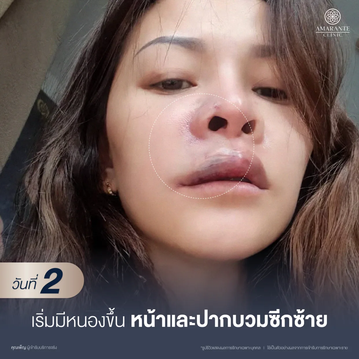 วันที่ 2 อาการเริ่มทรุดหนัก และเกิดการติดเชื้อจากฟิลเลอร์ปลอม
