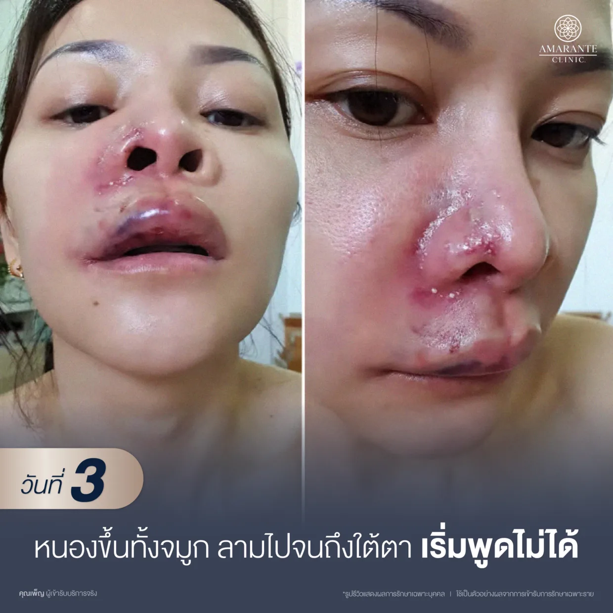 วันที่ 3 ปัญหาที่มีเริ่มวิกฤต และรู้สึกสิ้นหวังมากขึ้นเรื่อย ๆ