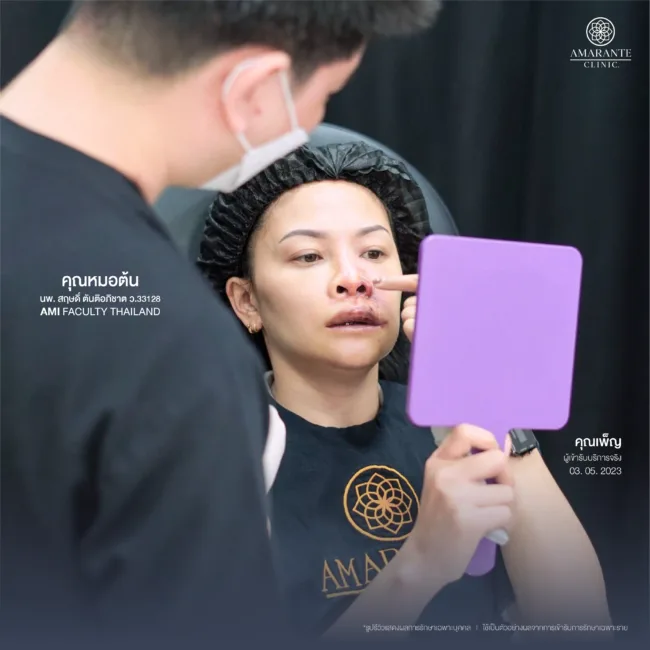 แก้ไขฟิลเลอร์ปลอมกับคุณหมอต้น ที่Amarante Clinic