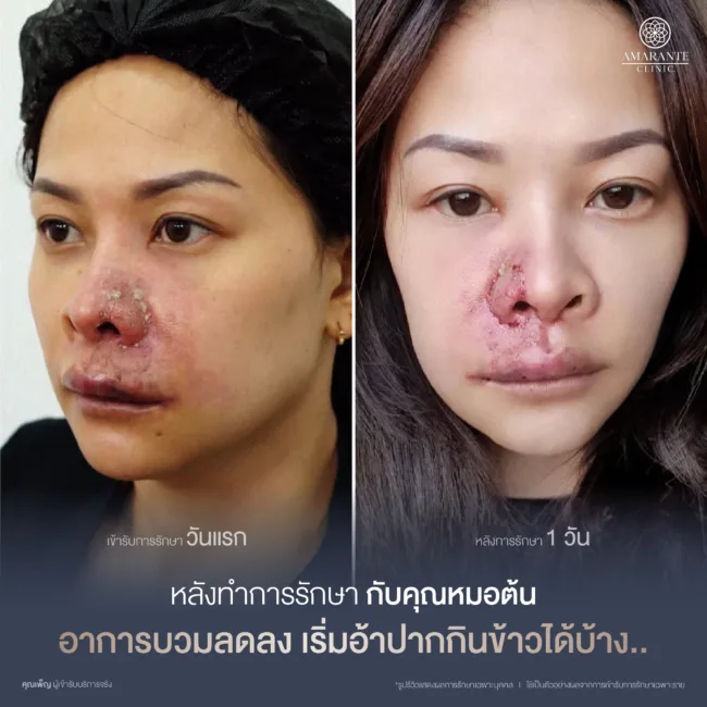 หลังแก้ไขฟิลเลอร์วันที่ 1