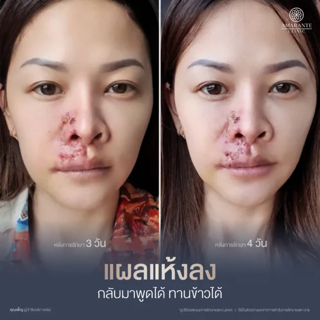 หลังแก้ไขฟิลเลอร์วันที่ 3-4