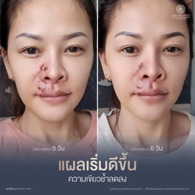 หลังแก้ไขฟิลเลอร์วันที่ 5-6