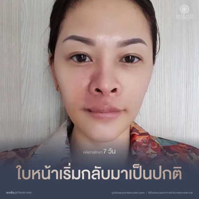 หลังแก้ไขฟิลเลอร์ปลอม 7 วัน