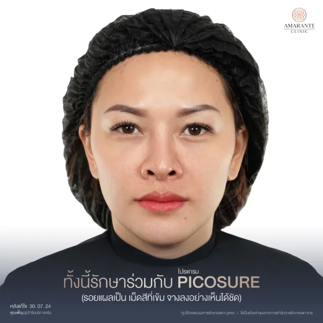 หลังจากแก้ไขฟิลเลอร์ปลอม รักษาPICOSUREร่วมด้งย