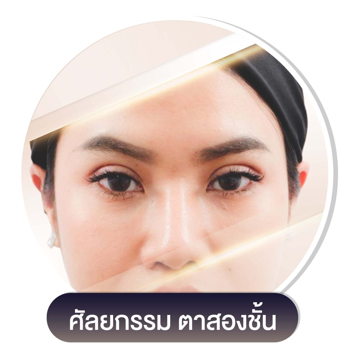 ศัลยกรรม ตาสองชั้น
