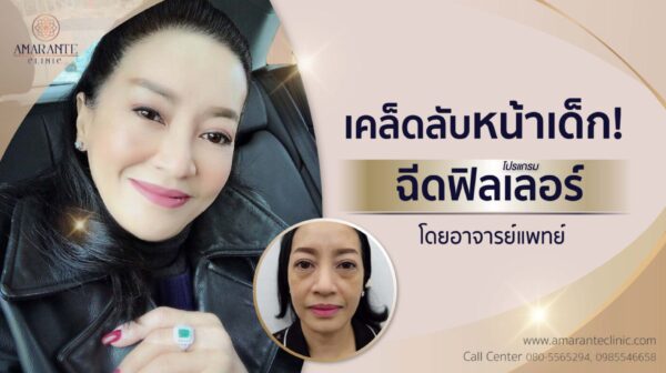 ฉีดฟิลเลอร์ใต้ตา ครั้งแรก