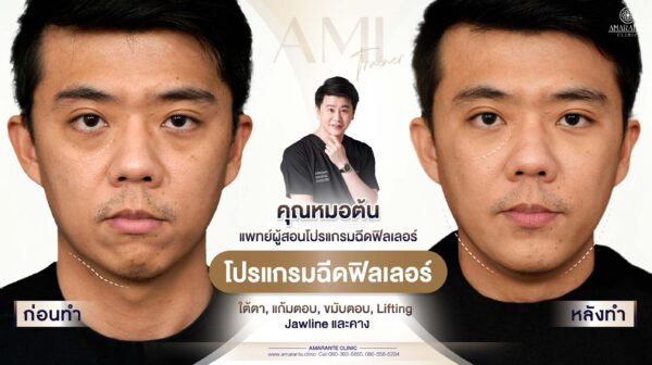 ฉีดฟิลเลอร์ใต้ตา รีวิว -01