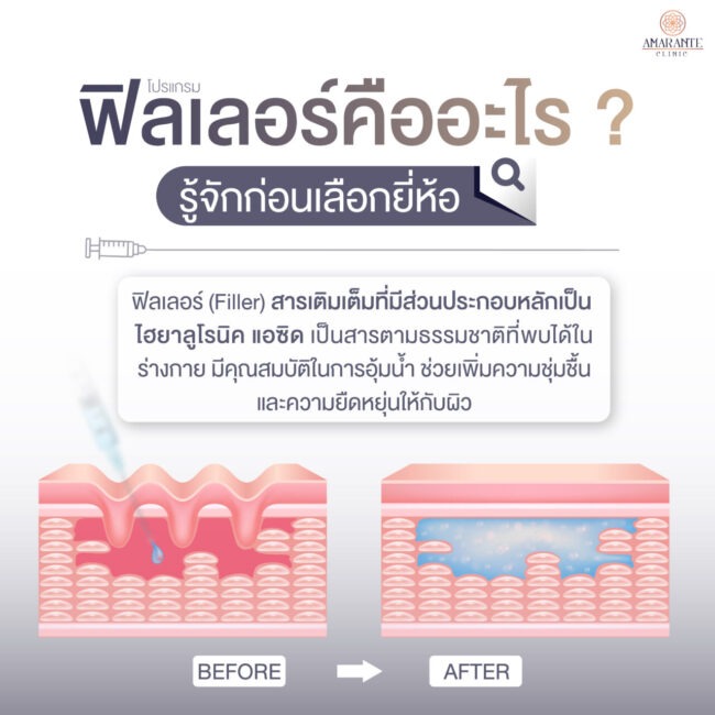 ฟิลเลอร์คืออะไร? รู้จักก่อนเลือกยี่ห้อ