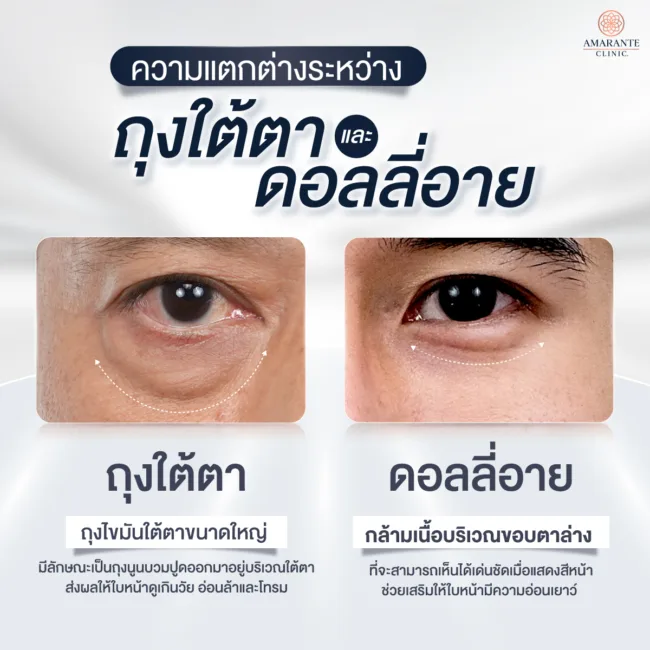 ความแตกต่างระหว่างถุงใต้ตา และ ดอลลี่อาย