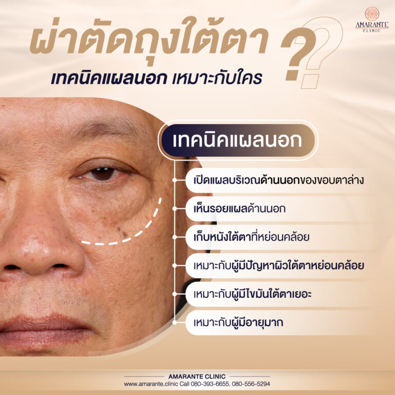 ผ่าตัดถุงใต้ตา เแผลนอก แผลเล็ก