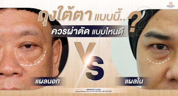 ผ่าตัดถุงใต้ตา แผลนอก vs แผลใน