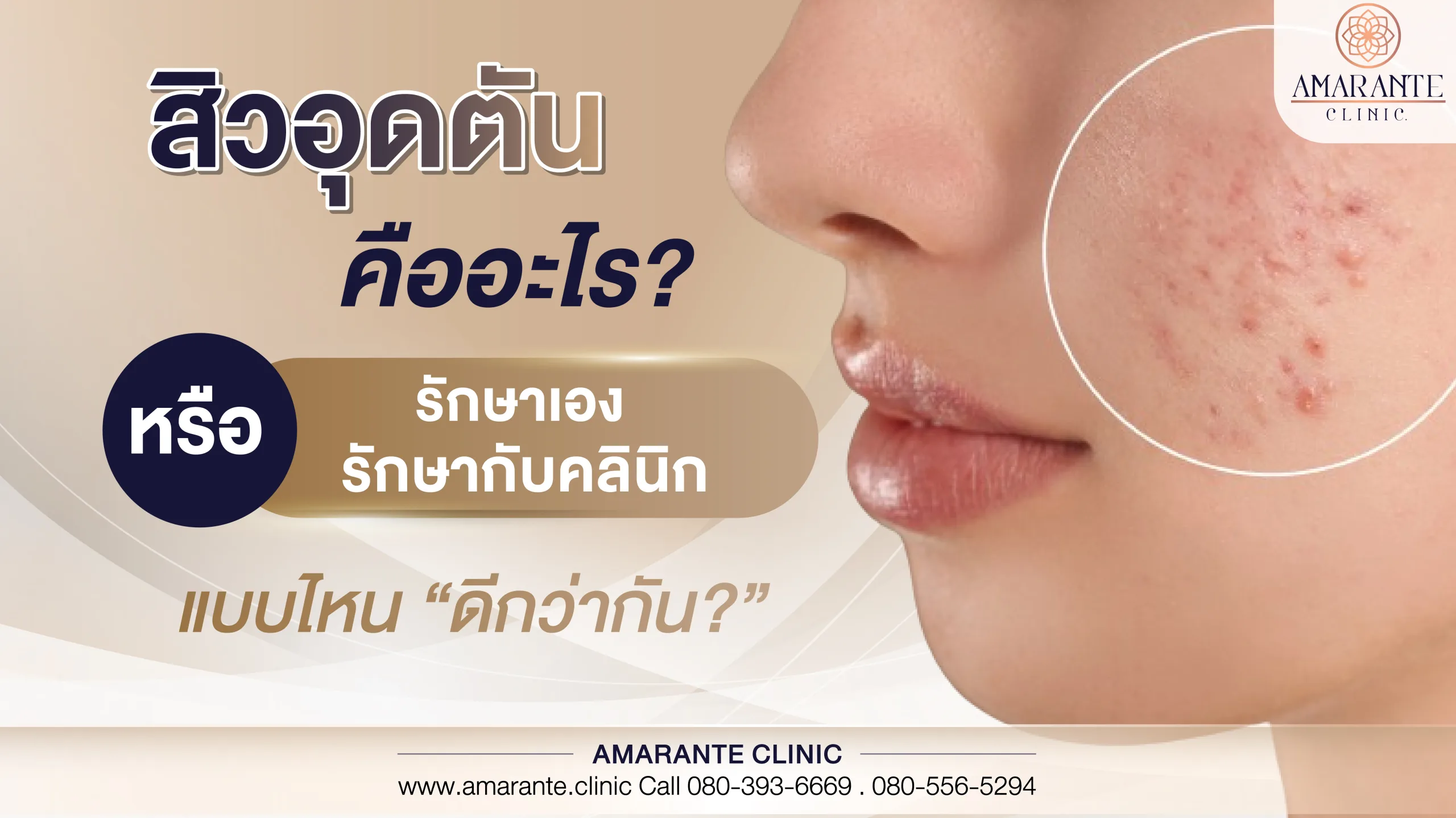 สิวอุดตัน เกิดจากอะไร รักษาเอง หรือ รักษากับคลินิก แบบไหนดีกว่ากัน