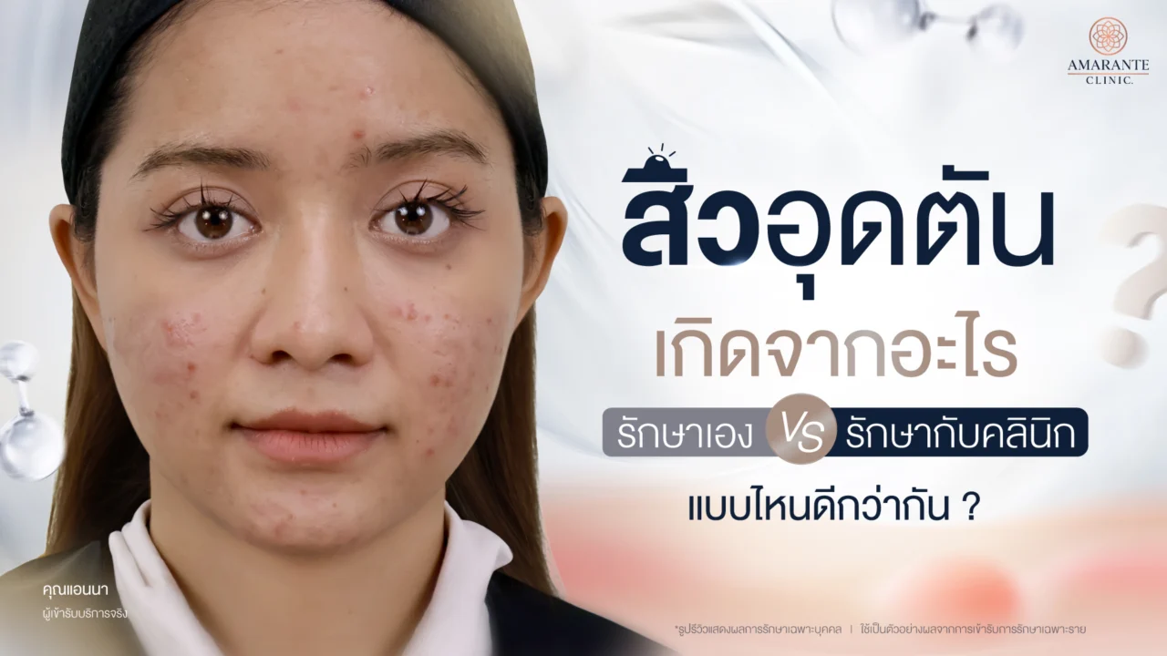 สิวอุดตัน เกิดจากอะไร รักษาเอง หรือ รักษากับคลินิก แบบไหนดีกว่ากัน