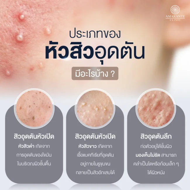 ประเภทของหัวสิวอุดตัน