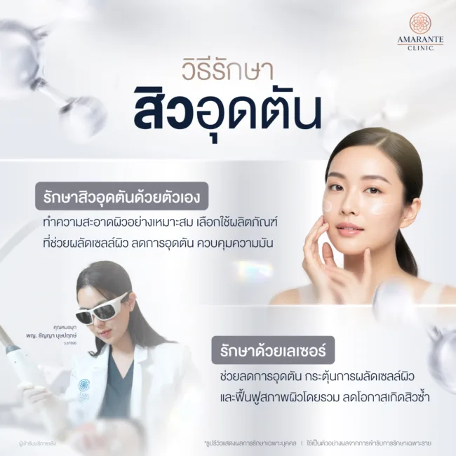 วิธีรักษาสิวอุดตัน