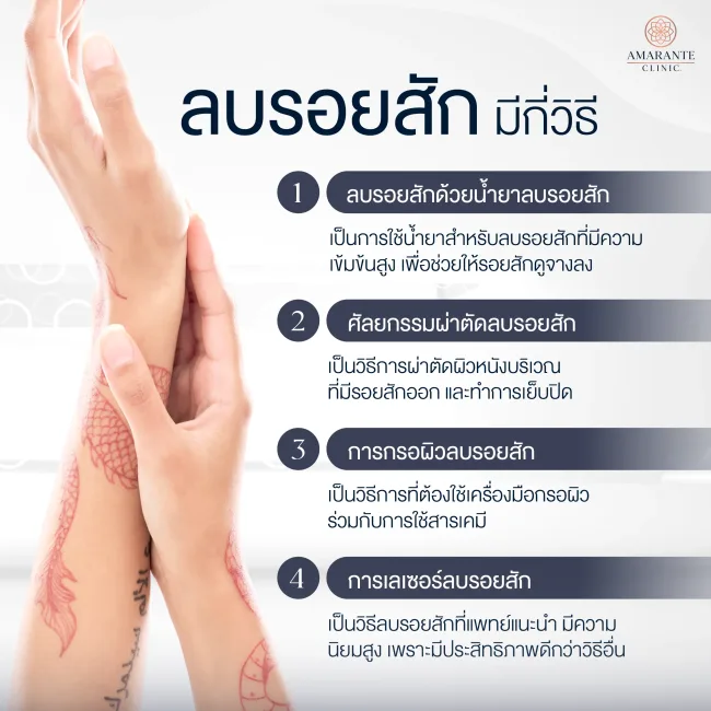 การลบรอยสักมีกี่วิธี