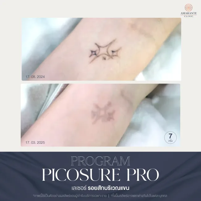 รีวิว ลบรอยสักบริเวณแขน ด้วย Pico pro laser