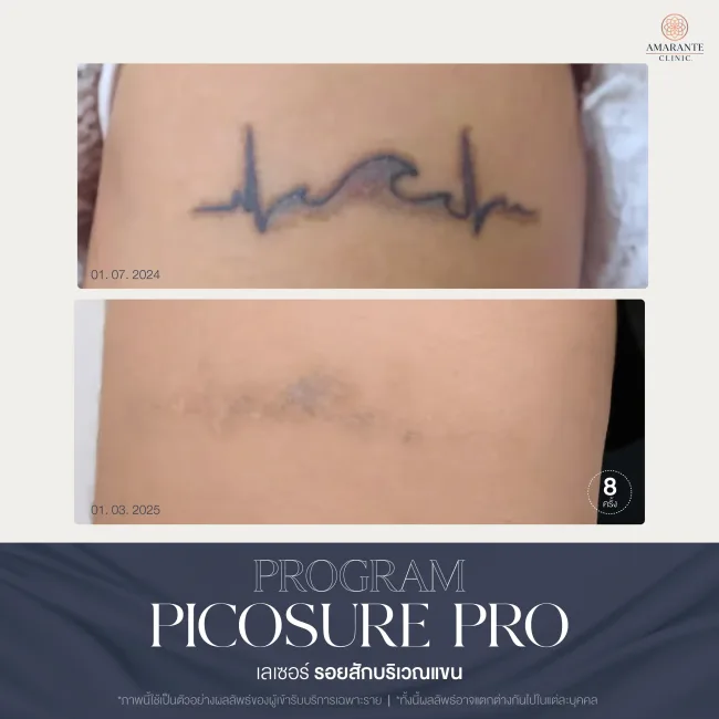 รีวิว ลบรอยสักบริเวณต้นแขน ด้วย Pico pro laser