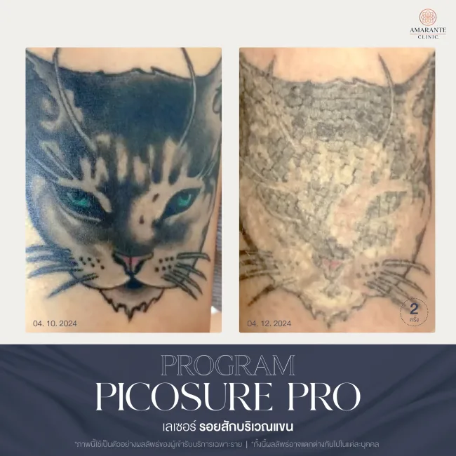 รีวิว ลบรอยสักบริเวณต้นแขน ด้วย Pico pro laser