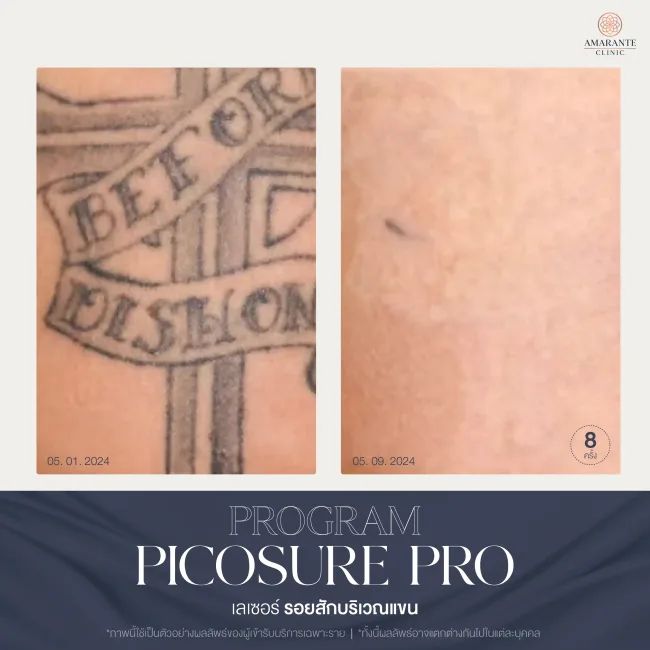 รีวิว ลบรอยสัก ด้วย Pico pro laser