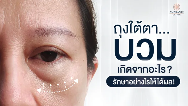 ถุงใต้ตาบวมเกิดจากสาเหตุใด และรักษาอย่างไรให้ได้ผล