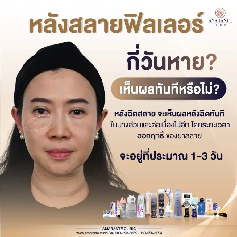 หลังฉีดสลายฟิลเลอร์กี่วันหาย