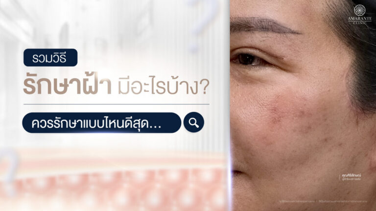 วิธีรักษาฝ้า