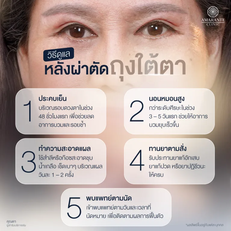 วิธีดูแลหลังผ่าตัดถุงใต้ตา