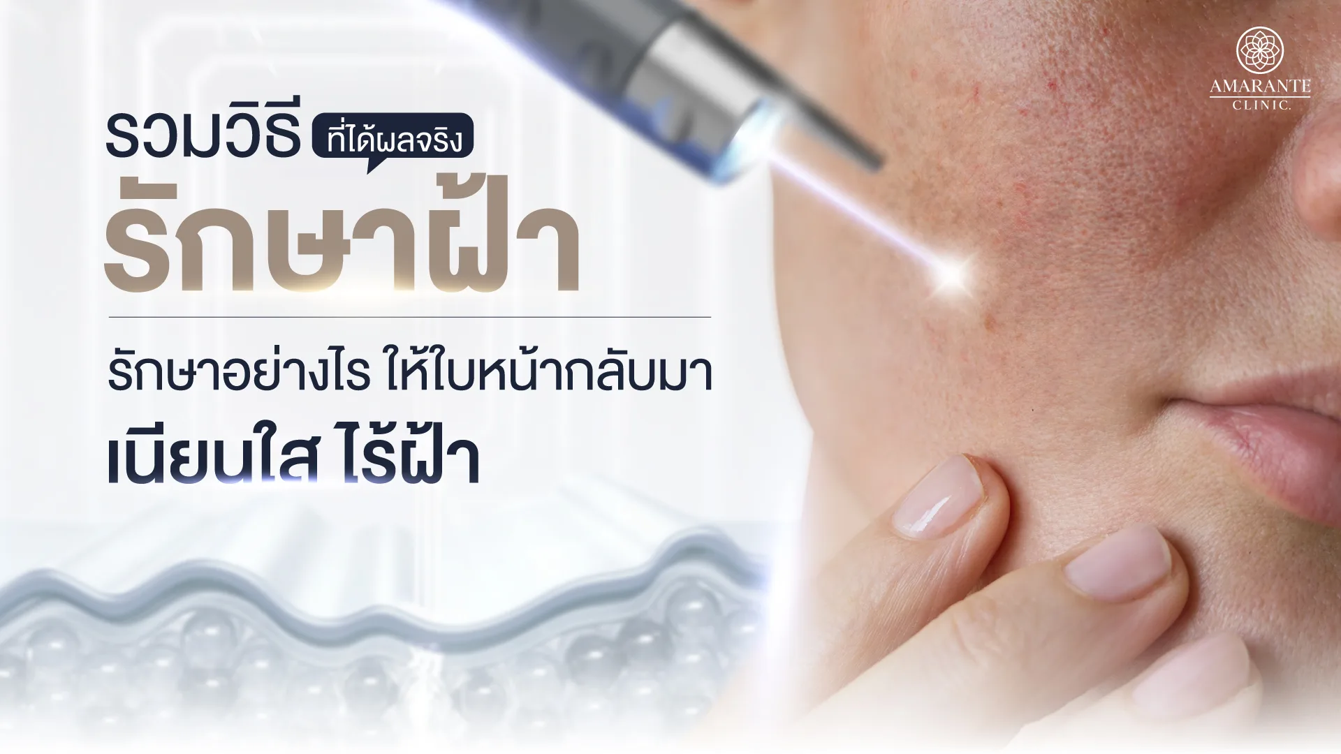 รวมวิธีรักษาฝ้า