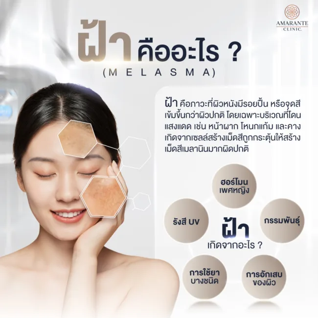 ฝ้าคืออะไร