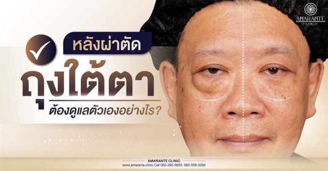 หลังผ่าตัดถุงใต้ตา