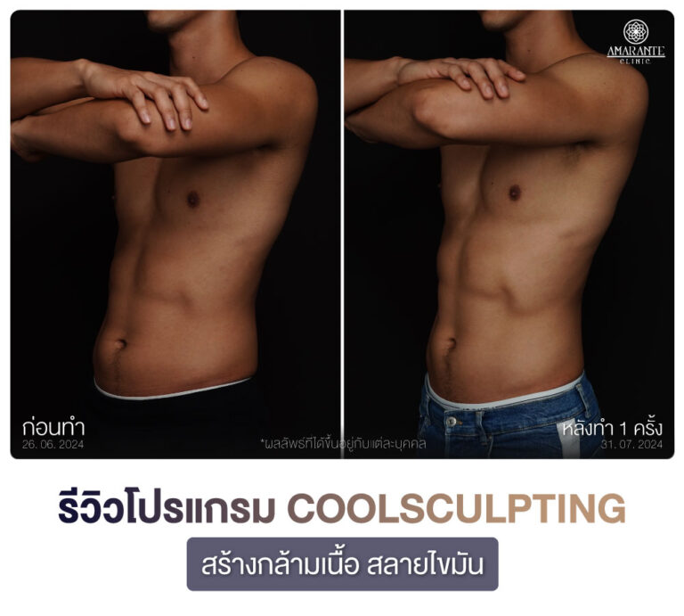 ภาพรีวิว CoolSculpting สร้างกร้ามเนื้อ สลายไขมัน เคสลูกค้าผู้ชาย มุม 45 องศา