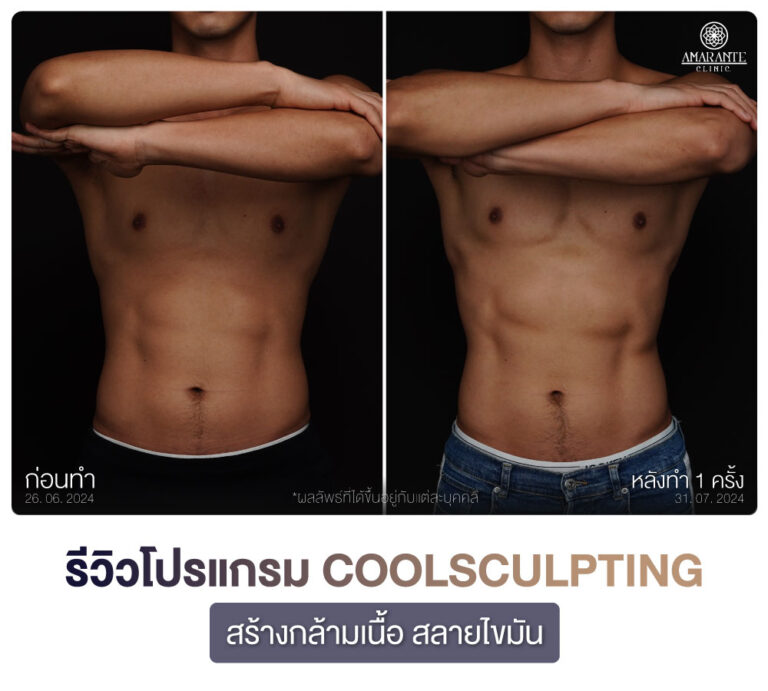 ภาพรีวิว CoolSculpting สร้างกร้ามเนื้อ สลายไขมัน เคสลูกค้าผู้ชาย มุมตรง